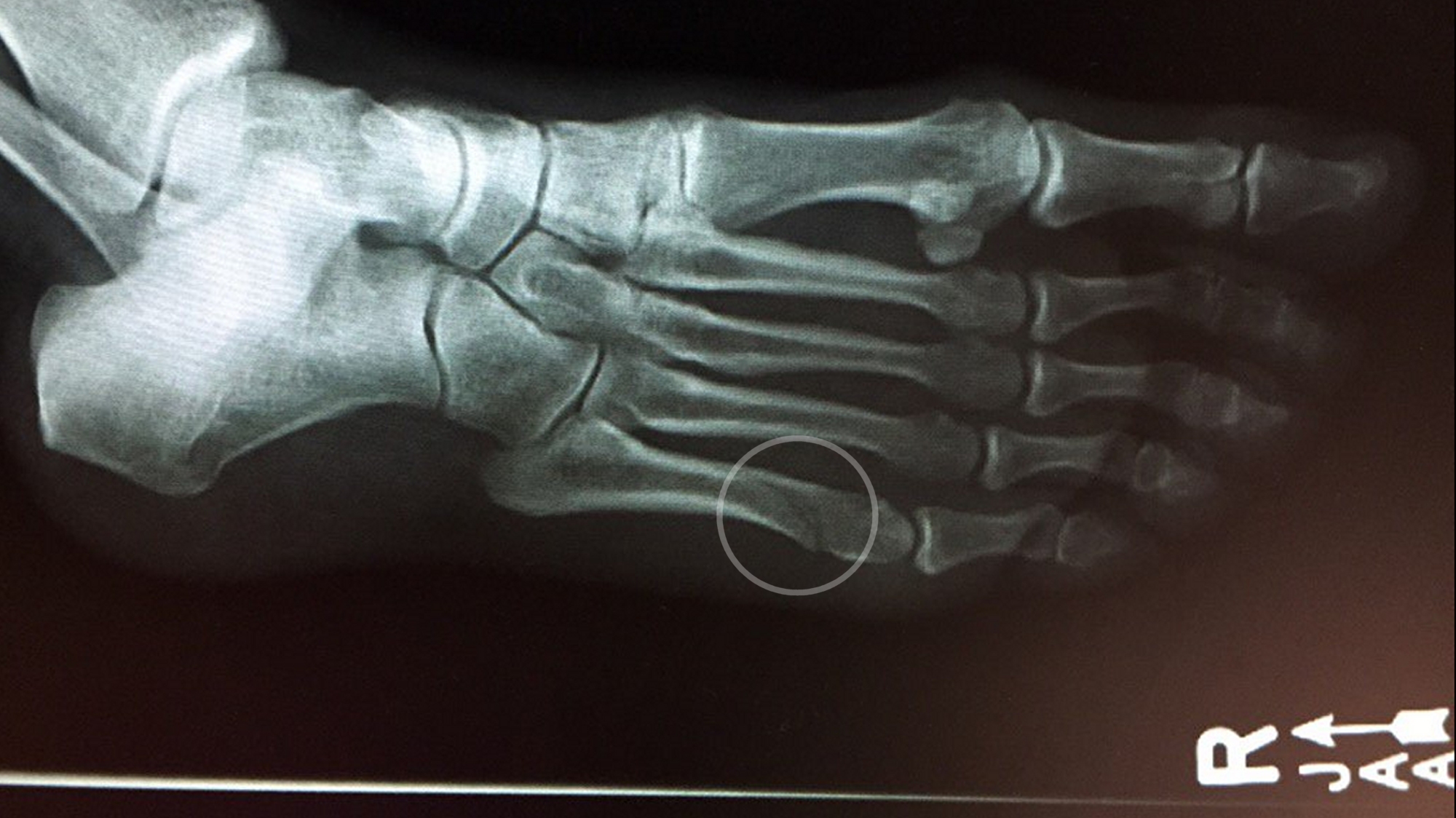 10 Things I Learned When I Broke My Foot